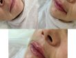 Филлеры на основе гиалуроновой кислоты помогают